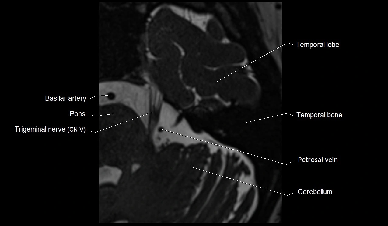 Internal auditory canal (IAC) axial cross sectional anatomy image 30.webp